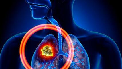 Quels sont les symptômes du cancer du poumon? Existe-t-il un traitement contre le cancer du poumon ?