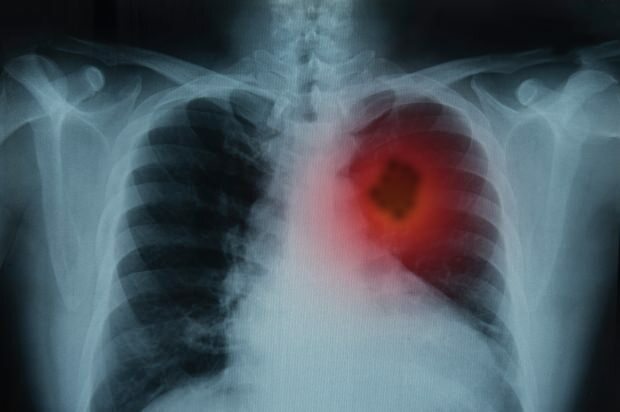 Quels sont les symptômes du cancer du poumon? Existe-t-il un traitement contre le cancer du poumon? Pour prévenir le cancer du poumon ...