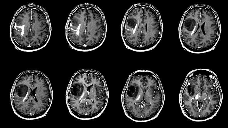Qu'est-ce qui cause une tumeur au cerveau? Quels sont les symptômes d'une tumeur cérébrale? Le traitement des tumeurs cérébrales est-il difficile?