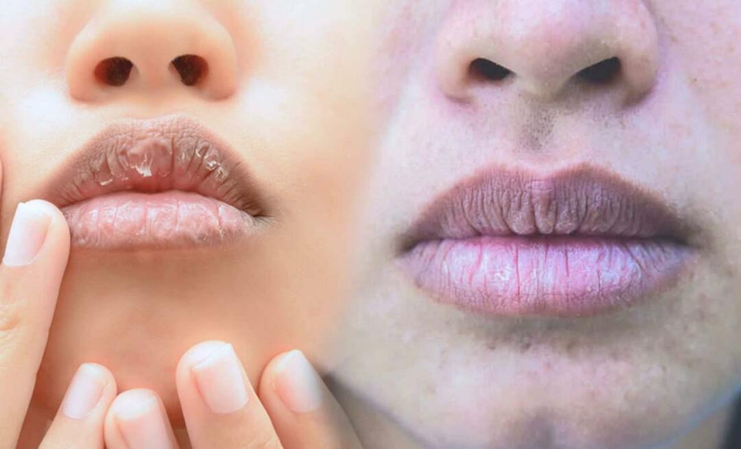 Qu'est-ce qui cause les lèvres foncées? Comment traite-t-on l'assombrissement des lèvres ou les ecchymoses ?