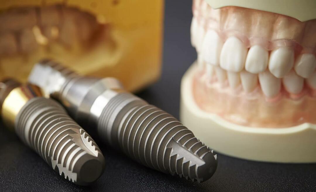 Tout le monde peut-il avoir des implants? Quels sont les avantages des implants ?