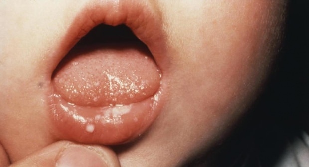 Comment une bouche est-elle douloureuse chez les bébés