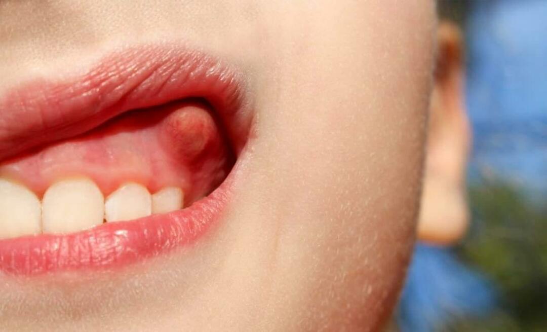 Pourquoi l'abcès dentaire et quels sont les symptômes? Abcès dentaire, comment se soigne-t-il ?