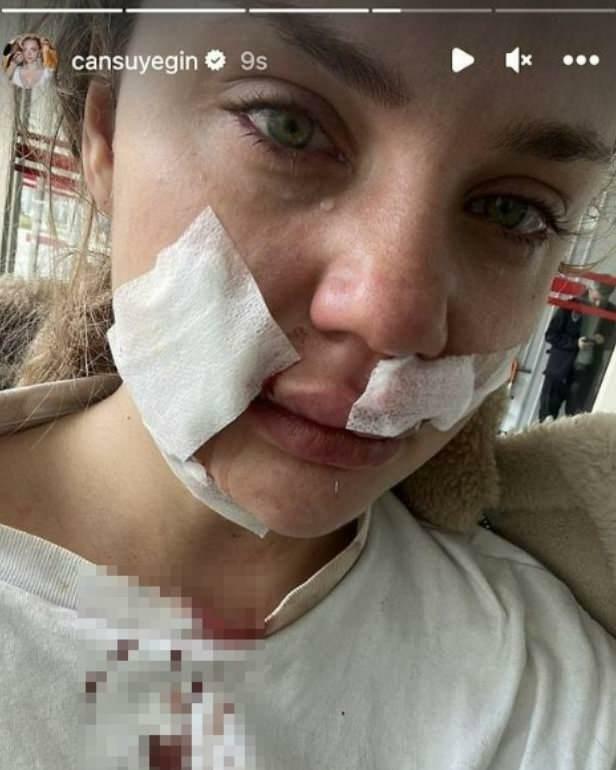 Cansu Yeğin a été attaqué par un chien