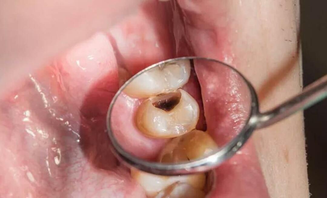 Pourquoi les dents pourrissent-elles et que pouvons-nous faire pour l'empêcher? 
