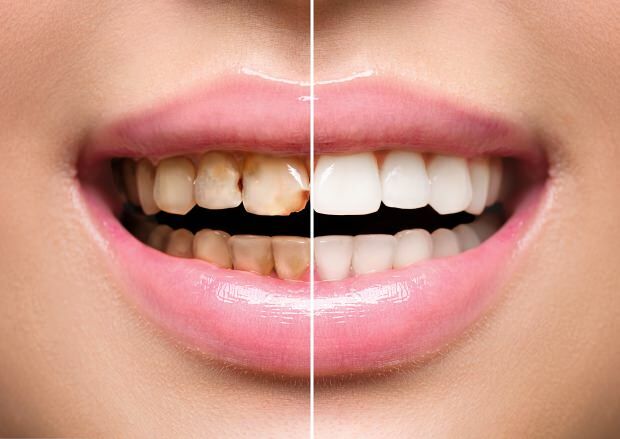 En raison d'une nutrition malsaine, une décoloration et une perte de dents se produisent