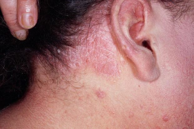 Quels sont les symptômes de la dermatite séborrhéique et qui apparaît-elle? Les aliments qui déclenchent la maladie