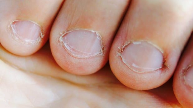 Qu'est-ce que la maladie des ongles? Quelles sont les maladies provoquées par l'ongle?