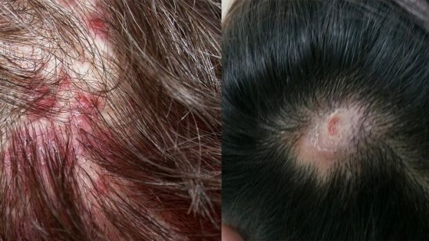 Pourquoi l'acné apparaît-elle sur le cuir chevelu