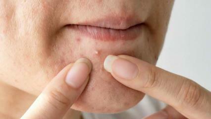 Pourquoi l'acné apparaît-elle sur le menton? Solution naturelle pour l'acné sur le menton
