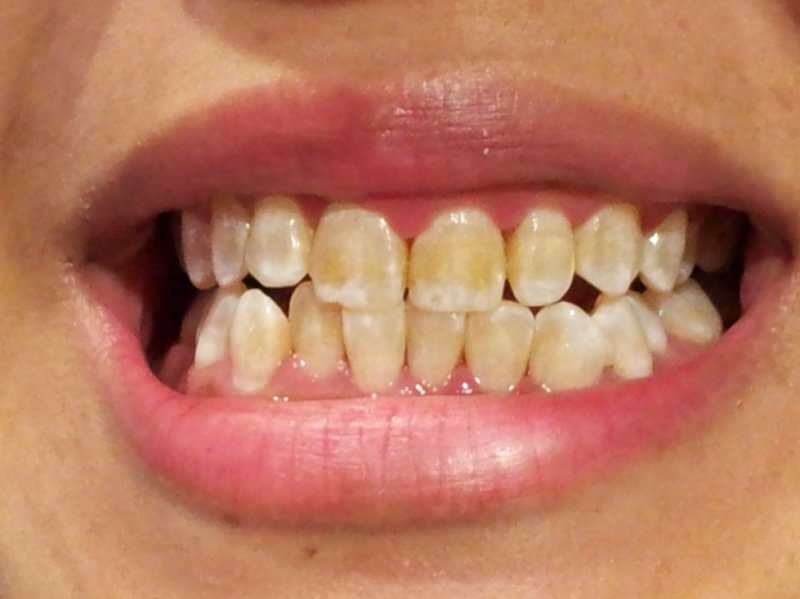 image d'une personne dont les dents commencent à s'assombrir