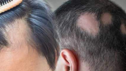 Qu'est-ce que la teigne (Alopecia areata)? Quels sont les symptômes de la teigne? Solutions efficaces pour la teigne