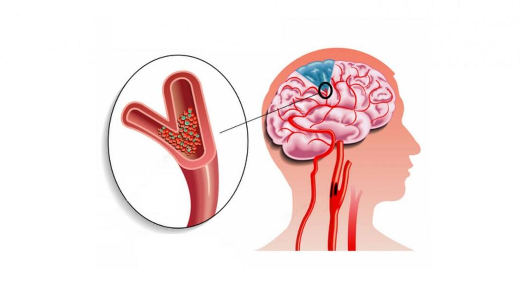 Qu'est-ce qu'une embolie et pourquoi se produit-elle? Quels sont les symptômes de l'embolie? Comment traiter l'embolie