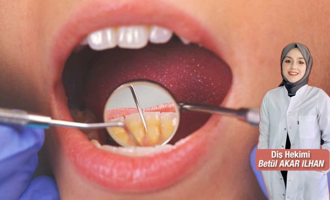 Que faire pour éviter le tartre? Quels sont les avantages du détartrage dentaire ?
