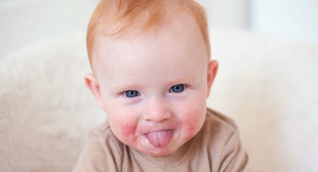 Attention aux bébés aux joues rouges! Syndrome des joues giflées et ses symptômes