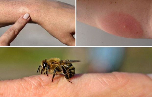symptômes d'allergie aux abeilles