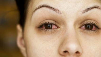 Qu'est-ce que la conjonctivite (grippe oculaire) et quels sont les symptômes? Comment se transmet la conjonctivite?
