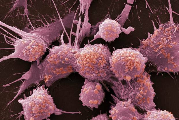 Qu'est-ce que le cancer et quels sont ses symptômes? Combien de types de cancer existe-t-il? Comment prévenir le cancer?