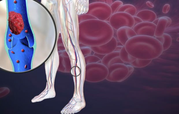 une diminution de la circulation sanguine dans les veines des jambes provoque des douleurs